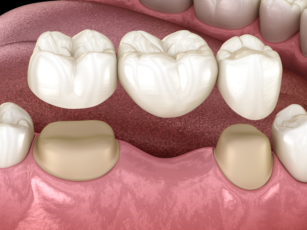 dental bridge