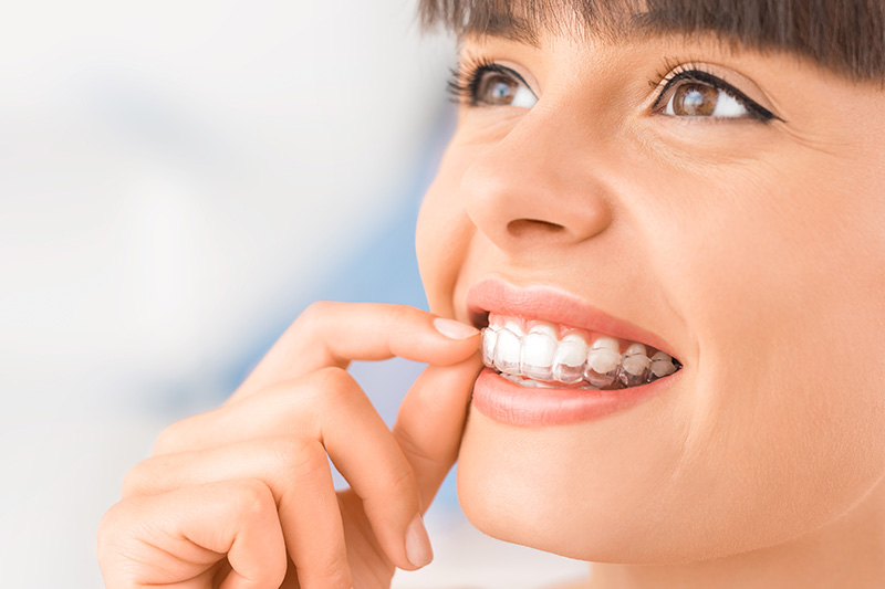 Invisalign in Indianapolis, Lafayette, and Anderson, IN